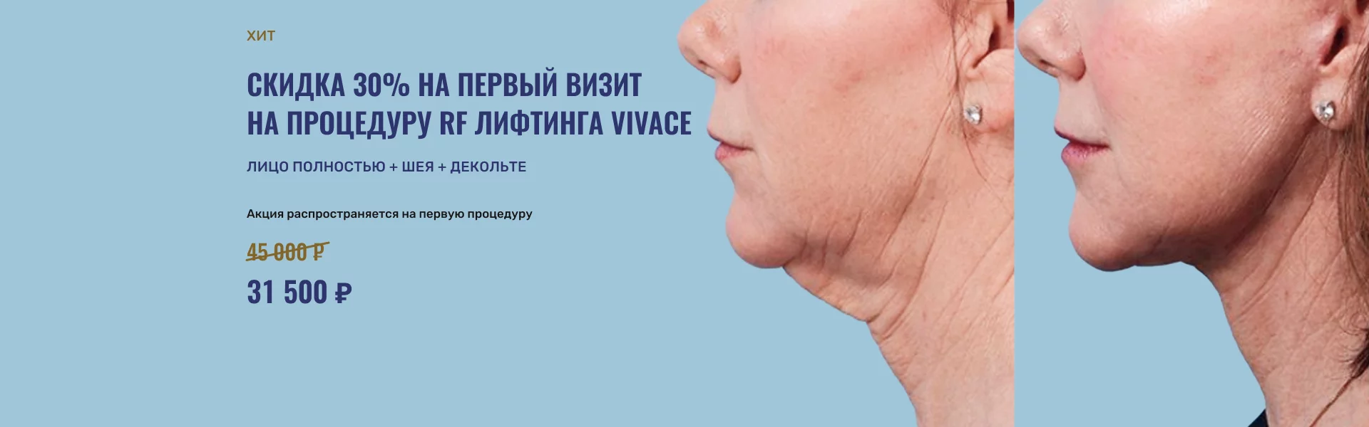 Акция на процедуру RF лифтинга VIVACE