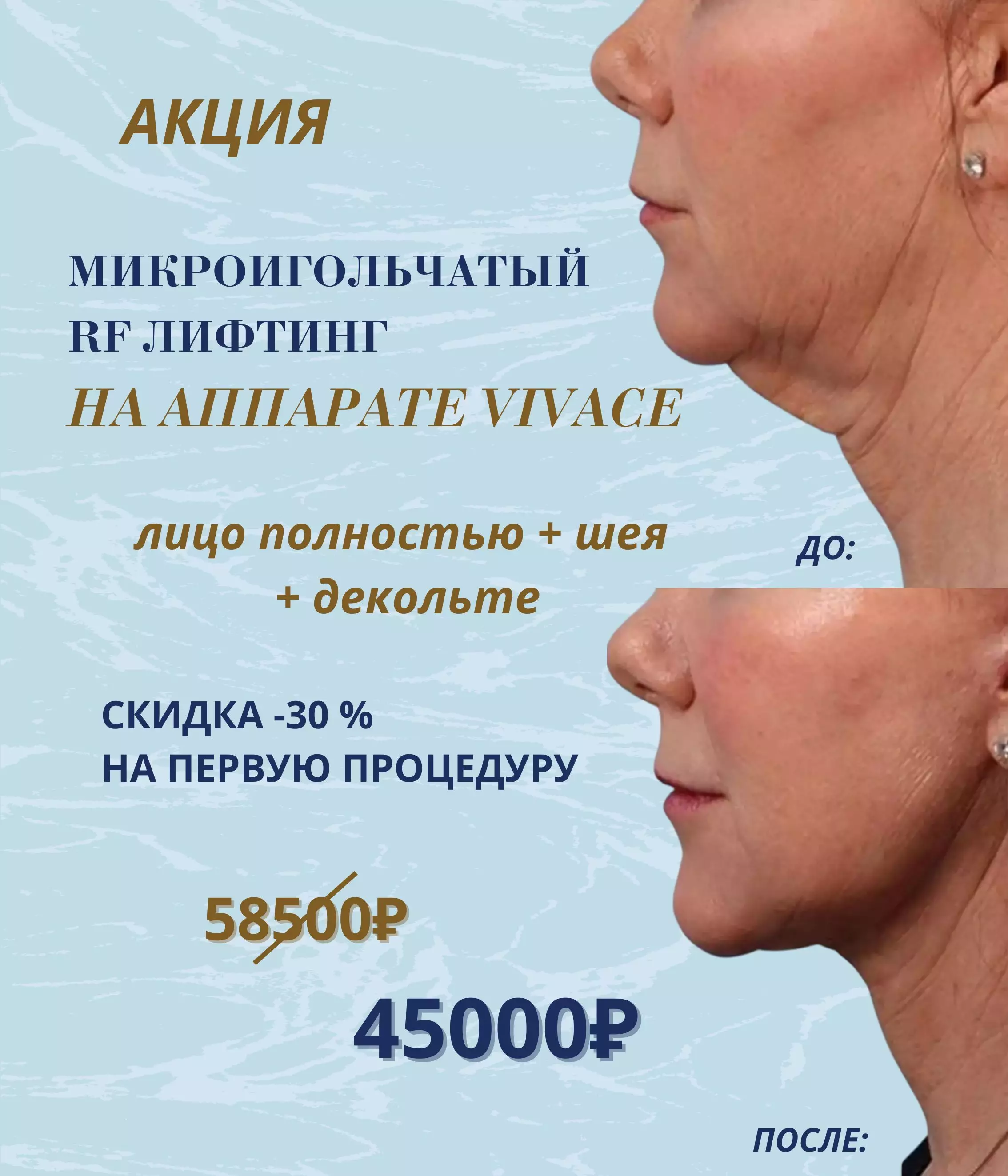 Акция на процедуру RF лифтинга VIVACE